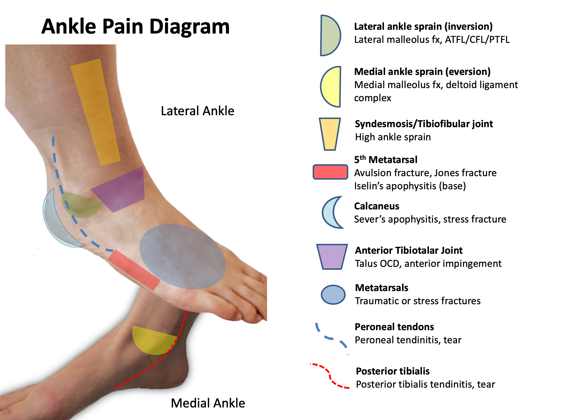 Ankle Pain Diagrams 