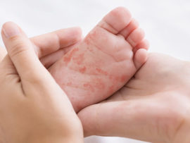 Hands holding baby's foot with rash