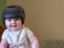 Baby girl wearing a cranial remoulding helmet flat head