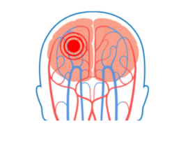 LIVE VIRTUAL: Pediatric Stroke Champions (September 26, 2025)